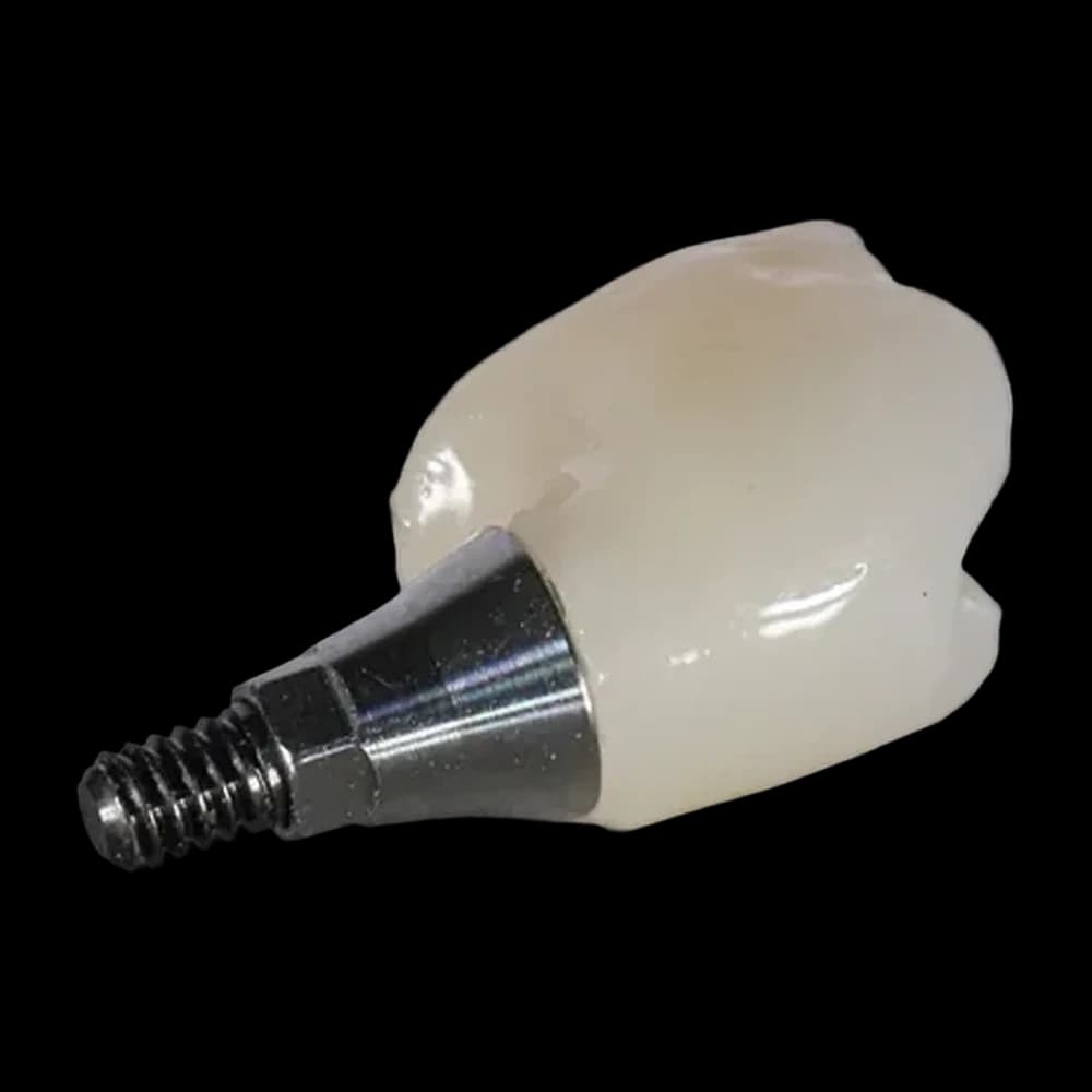 Couronne sur implant montée sur sa base